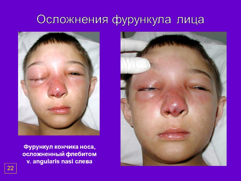 Осложнения фурункула лица Фурункул кончика носа, осложненный флебитом v. angularis nasi слева 22